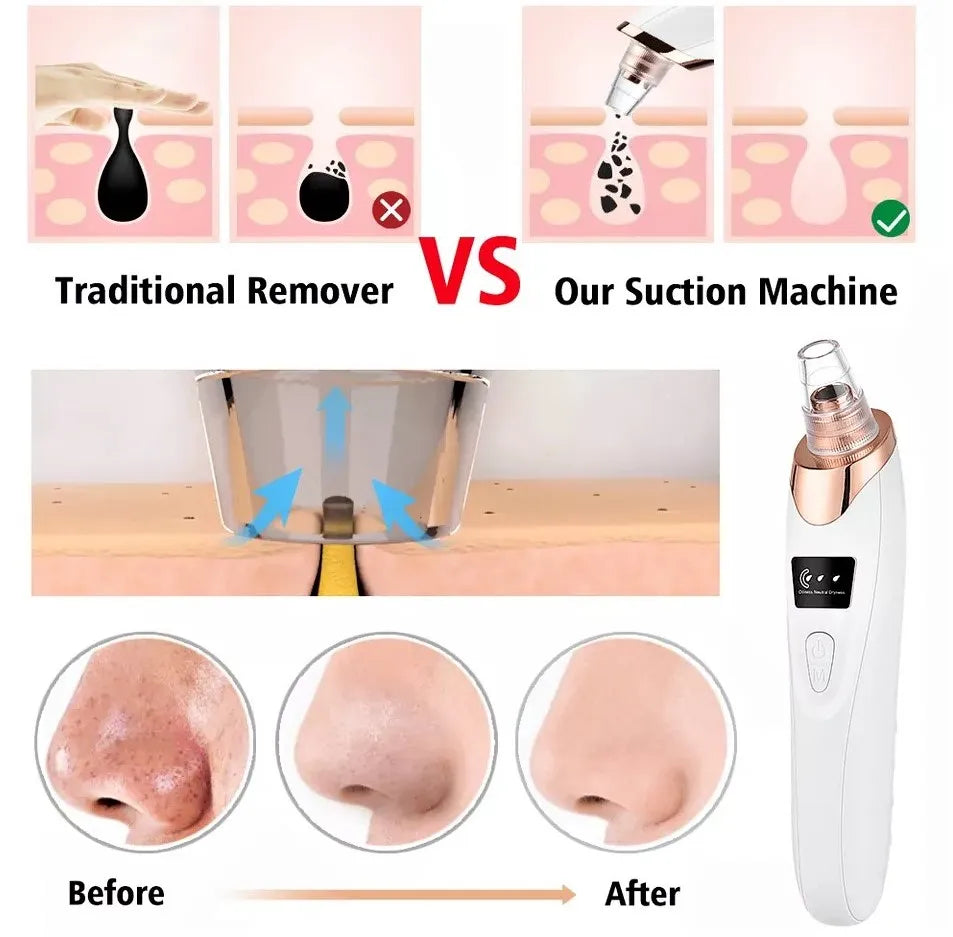 5-in-1 Rechargeable Blackhead Remover & Face Vacuum Derma Suction