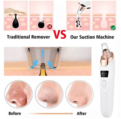 5-in-1 Rechargeable Blackhead Remover & Face Vacuum Derma Suction